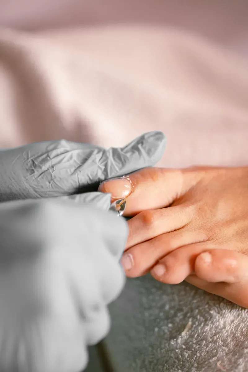 Aanbrengen van een nagelbeugel op een teennagel